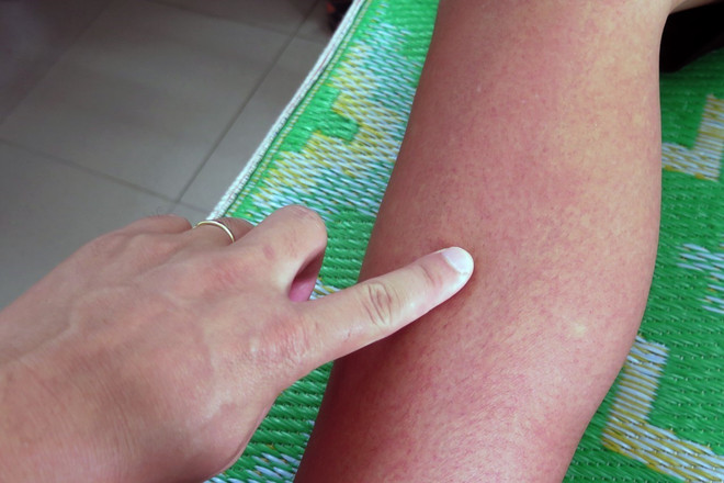 Sốt xuất huyết nặng có biểu hiện phát ban đỏ toàn thân. (Ảnh: Xuân Triệu/TTXVN) Ca mắc sốt xuất huyết đang tăng nhanh, Bộ Y tế phân tuyến điều trị ảnh 2