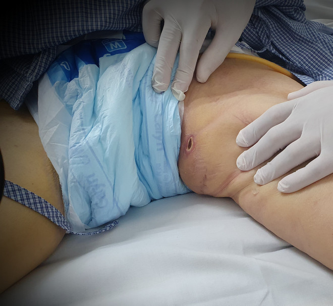 Vết loét điển hình trên vùng bẹn của bệnh nhân sốt mò. (Ảnh: PV/Vietnam+) Nữ bệnh nhân suy hô hấp, nhiễm trùng huyết vì vết loét do mò cắn ảnh 2