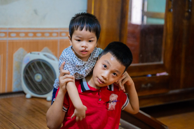 Bé Đạt và anh trai trước khi phẫu thuật. (Ảnh: PV/Vietnam+) 25.000 ca phẫu thuật mang lại nụ cười cho nhiều em nhỏ bị dị tật ảnh 2