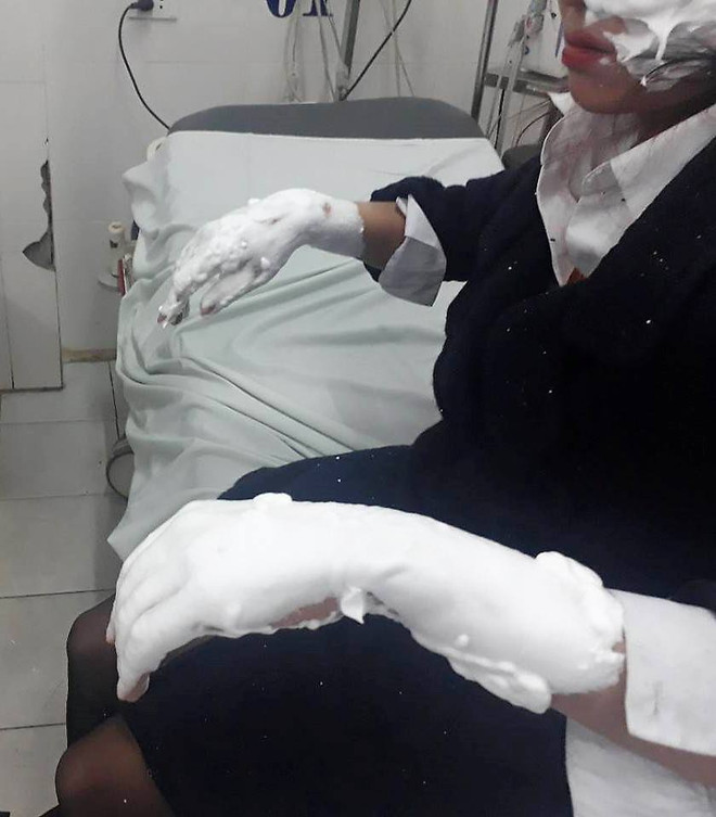 Hà Nội: Nổ bóng bay galaxy, ba sinh viên bị bỏng nặng ảnh 1