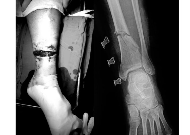 Tai nạn khi cắt cỏ, người đàn ông bị lưỡi cưa cắt đứt chân ảnh 1