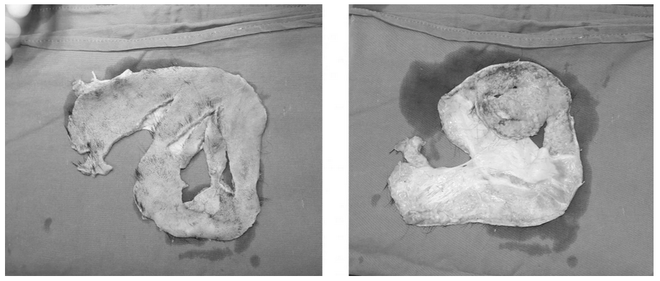Cứu sống 1 phụ nữ bị lóc toàn bộ da đầu nguy kịch nhất trong y văn ảnh 2