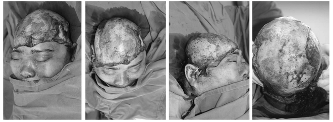 Cứu sống 1 phụ nữ bị lóc toàn bộ da đầu nguy kịch nhất trong y văn ảnh 3