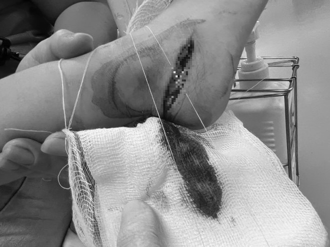 Phẫu thuật thành công cho bé 3 tuổi bị dao cứa đứt gân chân ảnh 1