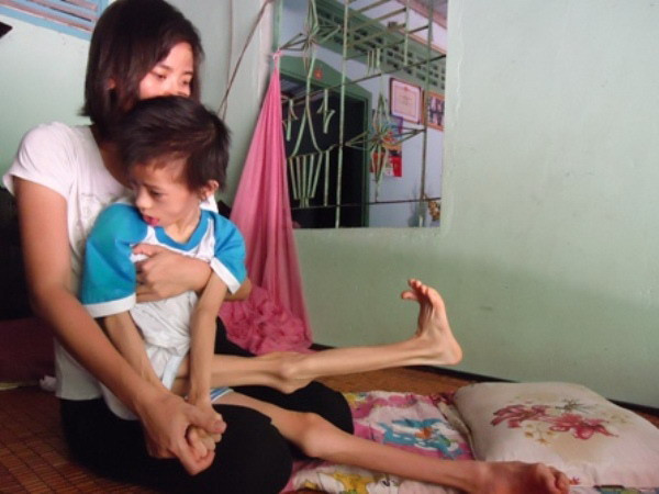 Vinmec ghép tế bào gốc chữa bại não thành công cho 1 bệnh nhân ảnh 1