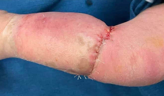 Bé trai 9 ngày tuổi mắc hội chứng vòng thắt cẳng chân bẩm sinh ảnh 2