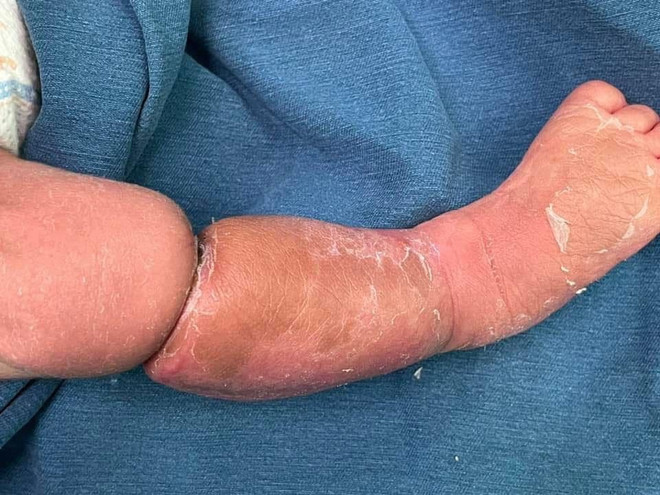 Bé trai 9 ngày tuổi mắc hội chứng vòng thắt cẳng chân bẩm sinh ảnh 1