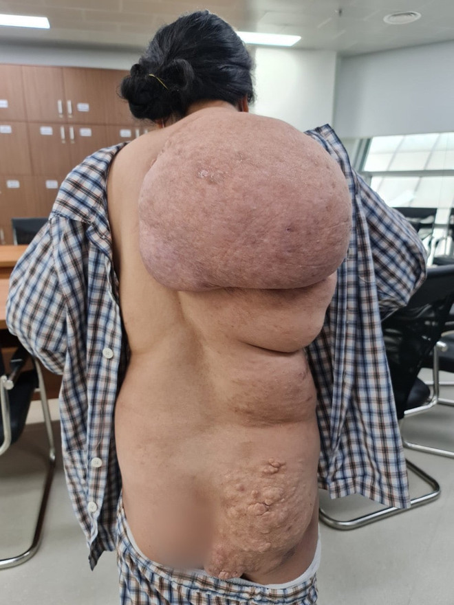 Nữ bệnh nhân gánh khối u khổng lồ dài từ vai xuống tới mông ảnh 2