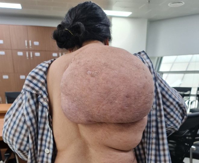 Nữ bệnh nhân gánh khối u khổng lồ dài từ vai xuống tới mông ảnh 1