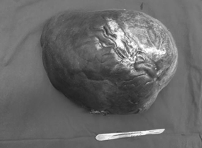 Cắt khối u gan nặng 5kg cho bệnh nhân mắc bệnh hiếm gặp ảnh 1