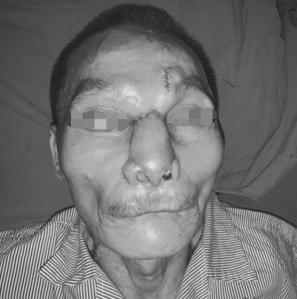 Phẫu thuật tái tạo toàn bộ mũi, má cho bệnh nhân ung thư da ảnh 1