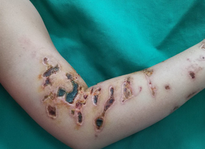 Bé trai 10 tuổi đầy rẫy vết thương trên cơ thể vì va chạm sứa biển ảnh 1