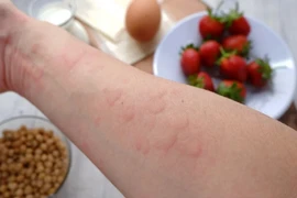 Ảnh minh họa. (Nguồn: Food Allergies Atlanta)