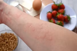 Ảnh minh họa. (Nguồn: Food Allergies Atlanta)