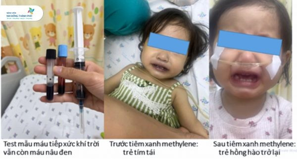 Bé gái tím tái, nguy kịch sau khoảng 1 giờ ăn ghẹ và canh cải bó xôi nấu với nước giếng. (Nguồn: Bệnh viện Nhi đồng Thành phố)