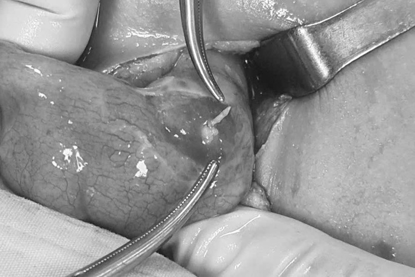 Phẫu thuật cho bé trai bị xương cá đâm thủng ruột. (Ảnh: TTXVN phát)