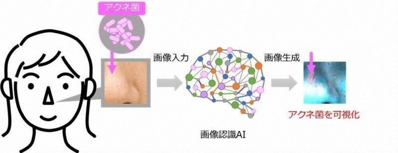 Hình ảnh do Lion Corp. cung cấp cho thấy công nghệ giúp hình dung vi khuẩn Cutibacteria Acnes chịu trách nhiệm gây ra mụn trứng cá. (Ảnh: mainichi)