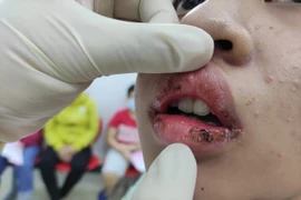 Làm đẹp bằng son giá rẻ không rõ nguồn gốc, môi thiếu nữ sưng tấy mủ