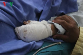 Pin điện thoại phát nổ khi sạc, một bé trai bị dập nát bàn tay