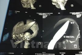 Hình ảnh chụp X-quang. (Ảnh do bệnh viện Nhi đồng 1 cung cấp)