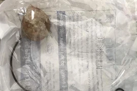 Hình ảnh viên sỏi bàng quang sau khi được lấy ra khỏi cơ thể bệnh nhân. (Ảnh: TTXVN phát)