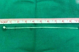 Con giun dài hơn 10cm trong não của ông Trương. (Ảnh: Pear Video)