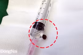 Dị vật là hạt tiêu được gắp ra khỏi đỉnh phổi bệnh nhân. (Nguồn: baodongnai.vn)