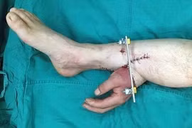 Bàn tay bị đứt lìa được ghép vào chân bệnh nhân. (Nguồn: Dailymail)