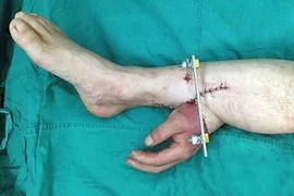 Bàn tay bị đứt lìa được ghép vào chân bệnh nhân. (Nguồn: Dailymail)
