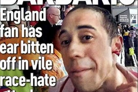 Một cổ động viên Anh bị cắn đứt tai trong trận đấu với Uruguay