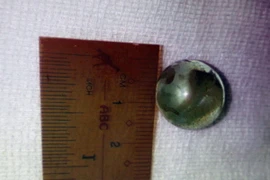 Viên bi được lấy ra trong mắt cho bệnh nhi Y Khương Mlo. (Ảnh: Phương Vy/TTXVN)