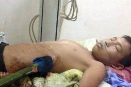 Cháu bé bị cây nứa đâm vào người. (Ảnh: Lan Anh/TTXVN)