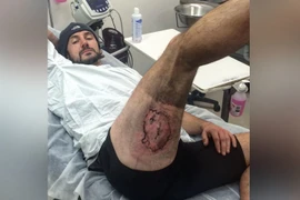 Bị bỏng mất cả mảng da đùi vì iPhone 6 phát nổ trong túi quần