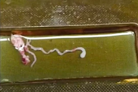 Trung Quốc: Cậu bé bị con sán dài 8cm ký sinh trong đầu