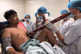 Thanh sắt đâm vào ngực của bệnh nhân. (Ảnh: PV/Vietnam+)
