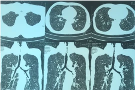 Hình ảnh chụp CT ngực của bệnh nhân cho thấy có tình trạng hẹp khí quản ở đoạn 1/3 trên. (Ảnh: BV cung cấp)