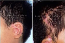 Các bác sỹ thực hiện phẫu thuật tạo hình tai nhỏ bằng sụn sườn tự thân cho bệnh nhân. (Ảnh: PV/Vietnam+)