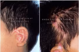 Các bác sỹ thực hiện phẫu thuật tạo hình tai nhỏ bằng sụn sườn tự thân cho bệnh nhân. (Ảnh: PV/Vietnam+)
