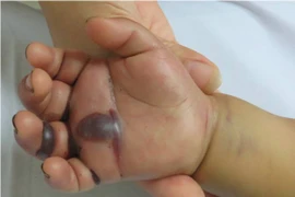 Cứu sống em bé 2 tuổi người H’Mông bị rắn độc cắn rất nặng