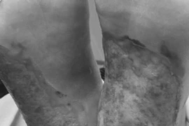 Bàn chân của ông Phạm Văn P. đã bị hoại tử. (Ảnh: PV/Vietnam+)