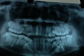 Phim chụp hình ảnh những răng thừa của bệnh nhân ở cả hai hàm. (Ảnh: PV/Vietnam+)