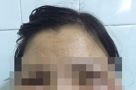 Khuân mặt biến dạng của bệnh nhân. (Ảnh: Bác sỹ cung cấp)