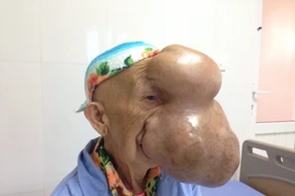 Triệu Mùi Chài với khối u khổng lồ trên mặt. (Ảnh:T.G/Vietnam+)