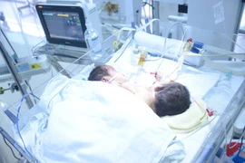 Cặp song sinh dính liền ở Hà Giang được gia đình xin đưa về. (Ảnh: PV/Vietnam+)