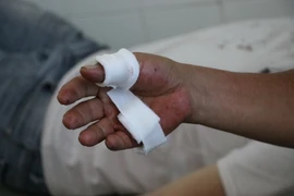 Bàn tay của một trong hai cha con bị trúng đạn. (Ảnh Đặng Tuấn/TTXVN)