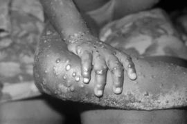 Bệnh nhân mắc đậu mùa khỉ ở Liberia. (Ảnh: Getty Images/TTXVN)