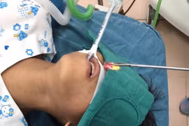 Viên thuốc còn cả vỏ gắp ra từ thực quản bệnh nhi 10 tuổi. (Nguồn: Bệnh viện cung cấp/thanhnien.vn)