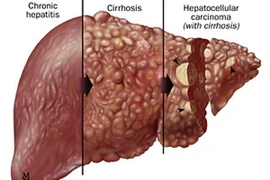 Nhật Bản phát hiện các ca đầu tiên nhiễm viêm gan E mãn tính