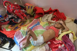 Trẻ em suy dinh dưỡng được điều trị tại bệnh viện ở Sanaa, Yemen ngày 6/10/2018. (Ảnh: AFP/TTXVN)
