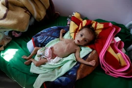  Trẻ em Yemen bị suy dinh dưỡng điều trị tại bệnh viện ở Sanaa. (Nguồn: AFP/TTXVN)